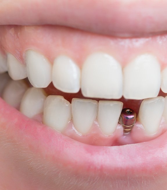 Someone smiling with implant visible in lower arch