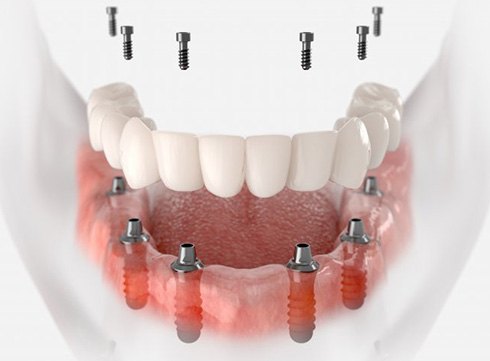 a 3D illustration of an implant denture