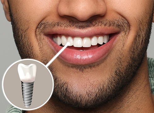 Nose-to-chin view of a man smiling with one tooth indicated as an implant