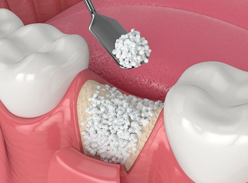 Illustration of bone graft in empty tooth socket