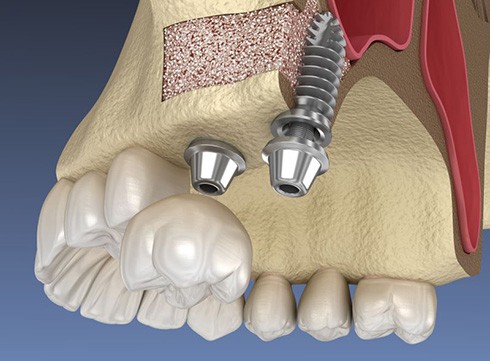 Illustration of implants in upper jaw after sinus lift