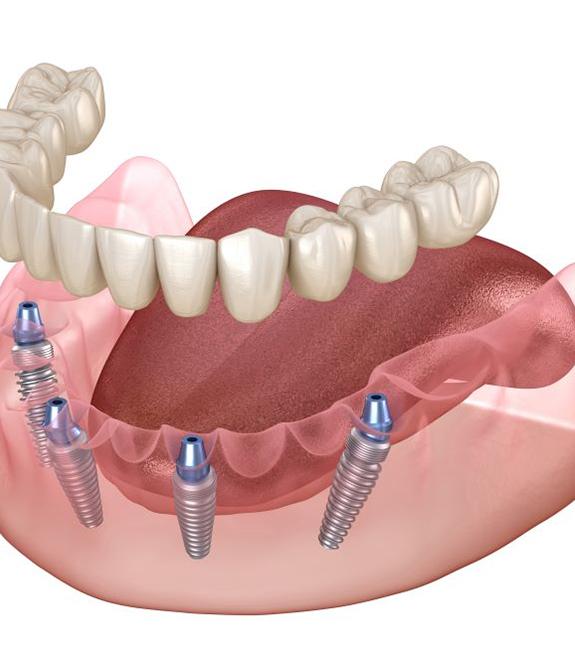 Illustration of All-on-4 dental implants in Corpus Christi