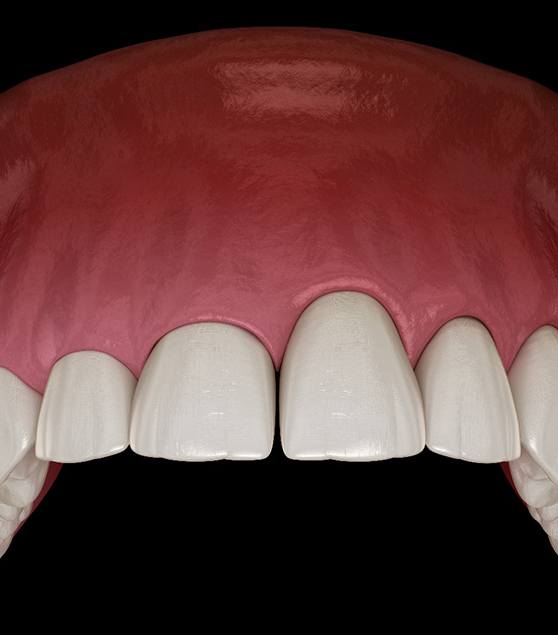 Illustration of upper row of teeth with uneven gumline before crown lengthening in Corpus Christi