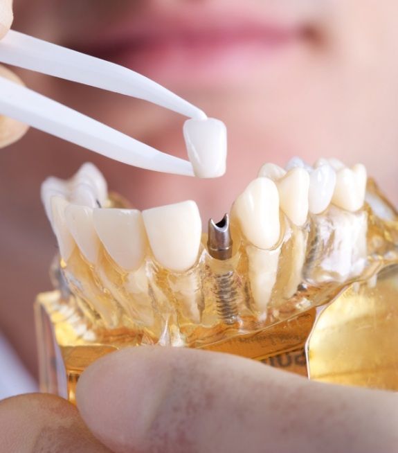 Dentist using model smile to explain the four step dental implant process