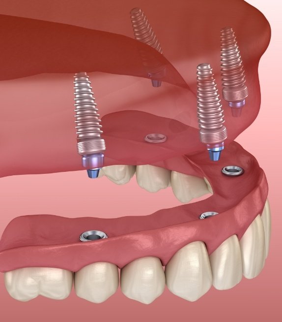 Animated smile during all on four dental implant denture placement