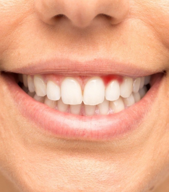 Closeup of smile with damaged gums before gum disease treatment