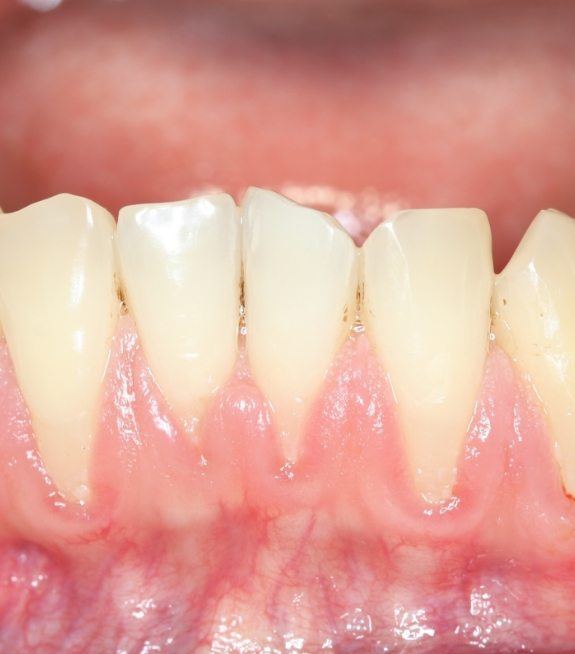 Closeup of smile with receding gums showing signs of gum disease