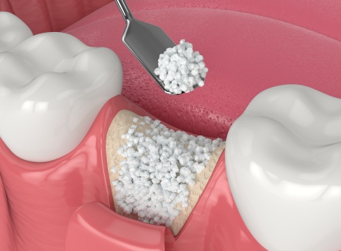 Digital illustration of a bone graft