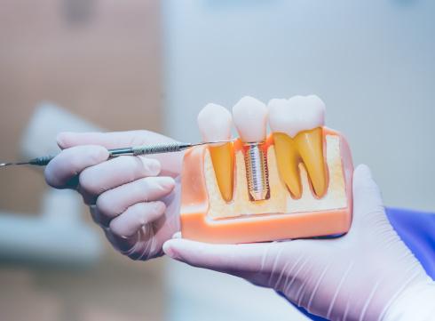 Woman pointing to a dental implant model