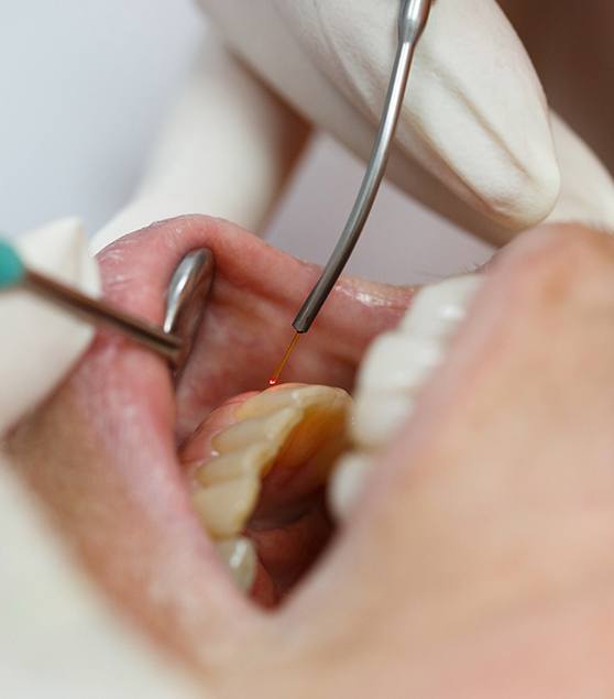 dentist using laser in mouth of patient