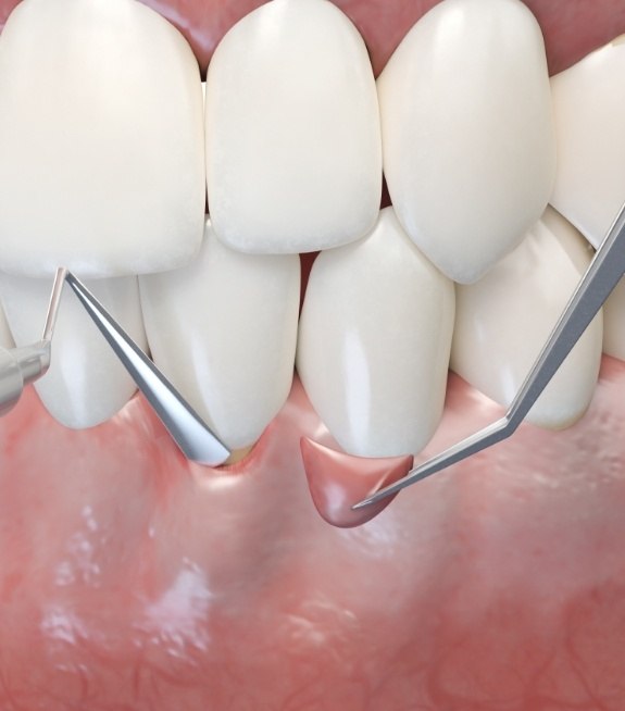 Animated smile during crown lengthening