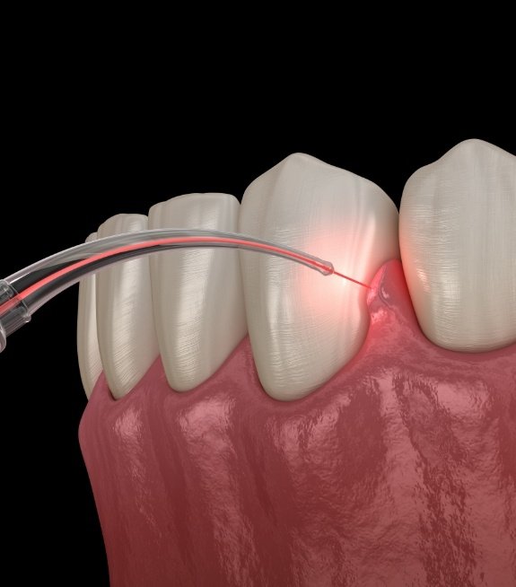 Animated smile during laser periodontal surgery