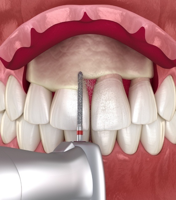 Animated smile during gingivectomy