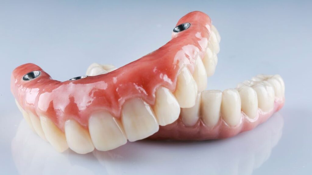 A pair of implant dentures